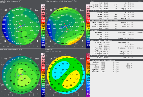 The Advanced IOL Display allows the individual selection of maps and index sections for a user-friendly and personalized report.