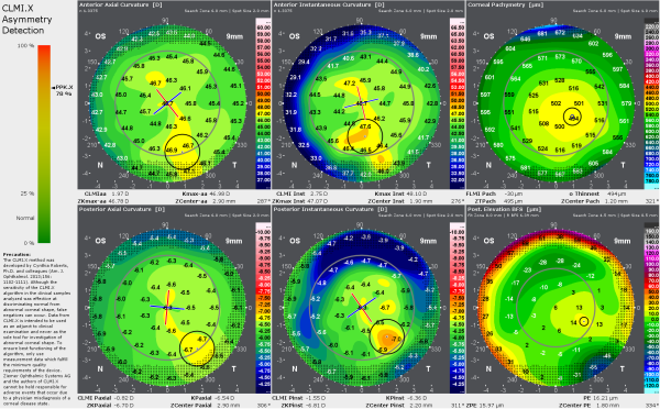 The CLMI.X asymmetry detection display shows in a simple and automated way whether the algorithm detected a suspicious pattern of asymmetries in the cornea.