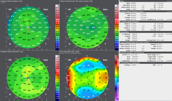 The Fast Refractive Screening Display of the GALILEI provides an overview of the cornea to start the analysis of the eye for refractive surgery planning.