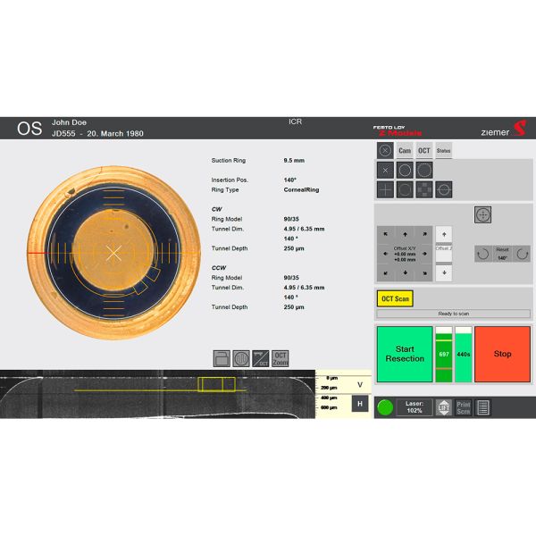 Centration of the intracorneal rings - with the FEMTO models, the tunnel incisions can be precisely centered on the monitor for more predictability in the outcome.