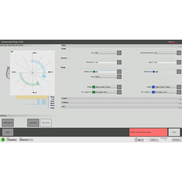 Customization of the intracorneal rings - the depth, the inner and outer diameters of the tunnel incisions, the axis, as well as the entry incision angles can be customized to best fit the patient's surgery plan and to avoid any migration of the ring segments. 