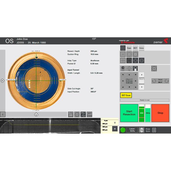 Centration of the intrastromal pockets - with the FEMTO models, the intrastromal pocket can be precisely centered on the monitor for more predictability in the outcome.