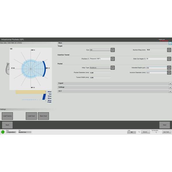 Customization of the intrastromal pockets - The depth and the pocket dimensions, as well as the entry incision size can be customized to best fit the patient's surgery plan. 
