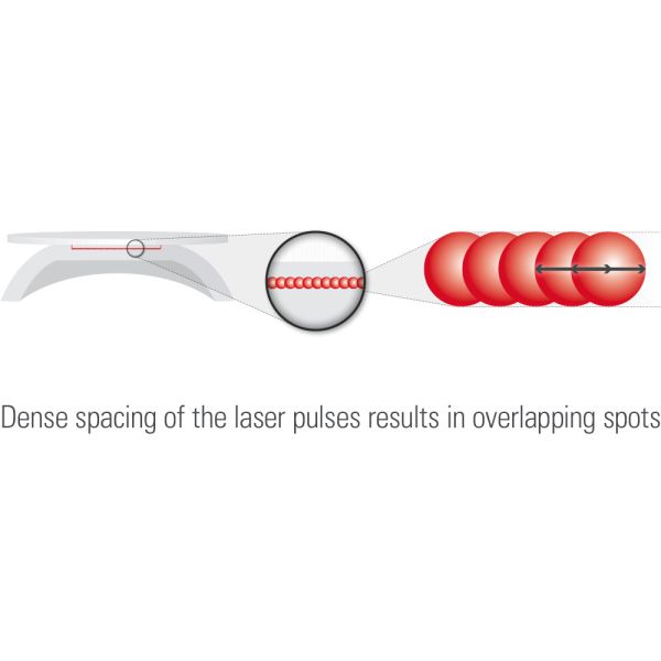 The FEMTO laser works in the low energy range to create a smooth stromal bed and edges.