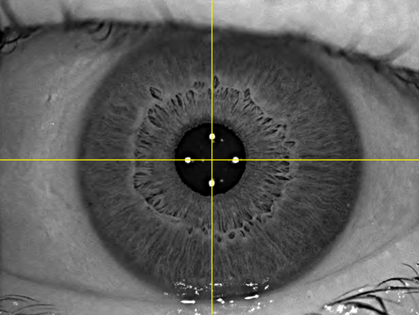 All maps and data is aligned to the same reference point, the 1st Purkinje reflex. This reflex is closest to the visual axis, resulting in highly accurate surface data and consistent alignment when comparing a series of consecutive measurements over time.