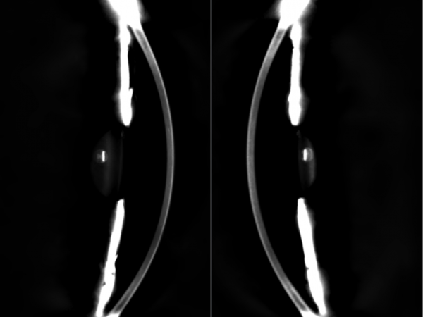 Dual-Scheimpflug Tomography - The GALILEI system is equipped with two Scheimpflug cameras, greatly reducing the time of the measurement process of the anterior segment.