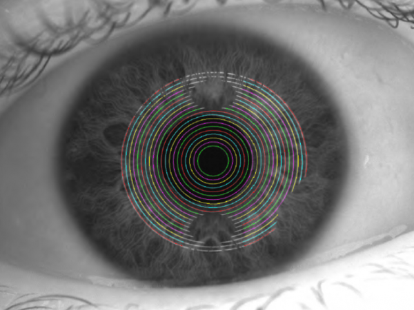 Placido topography delivers highly accurate anterior curvature data of the cornea. It can precisely detect anterior surface irregularities and tearfilm quality.